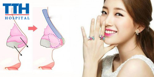 Phương pháp nâng mũi bọc sụn