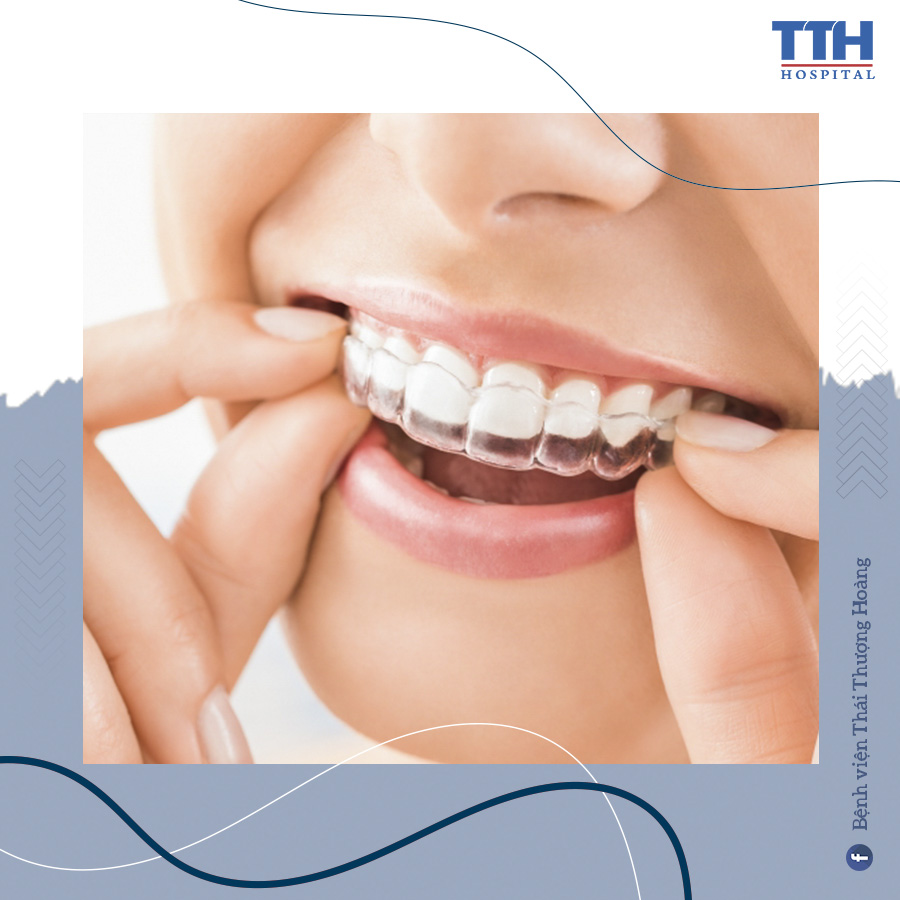 Hướng dẫn đeo khay niềng