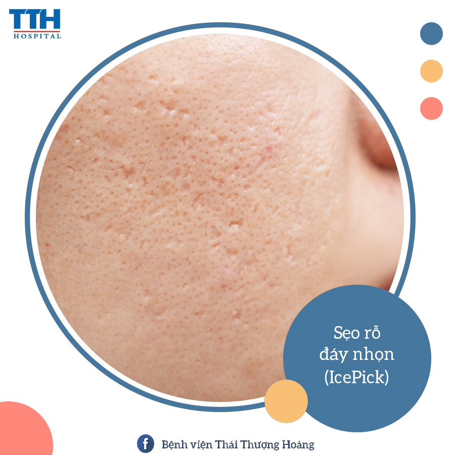 PHÂN LOẠI CÁC LOẠI SẸO MỤN