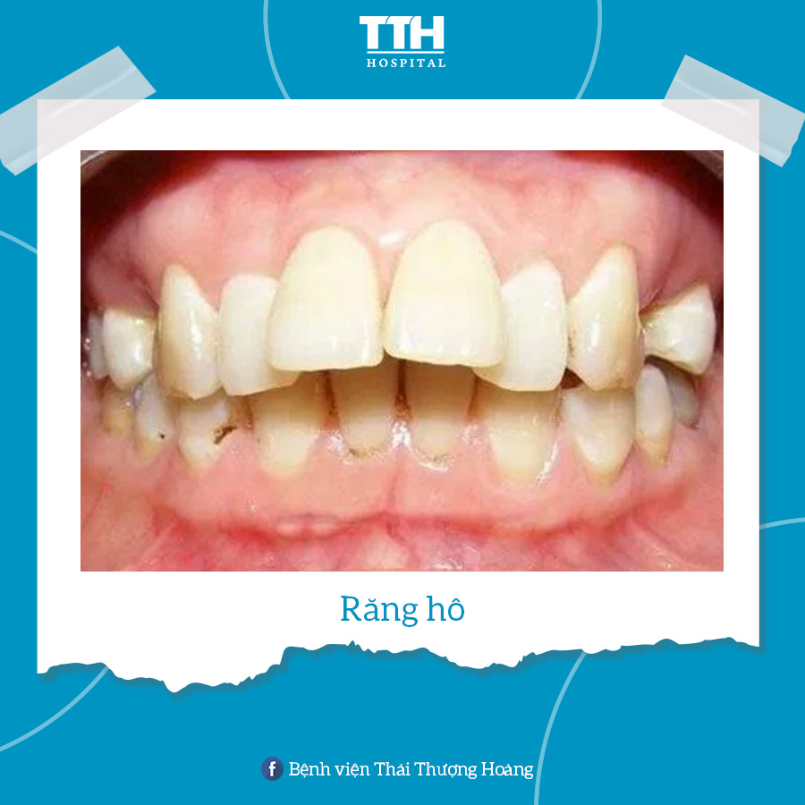Răng hô là tình trạng răng hàm trên nằm quá xa về phía trước so với răng hàm dưới