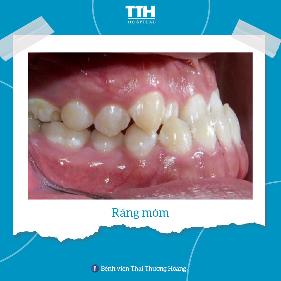 Móm là tình trạng răng hàm dưới đưa ra xa về phía trước so với răng hàm trên hoặc răng hàm trên đưa sâu vào bên trong so với răng hàm dưới
