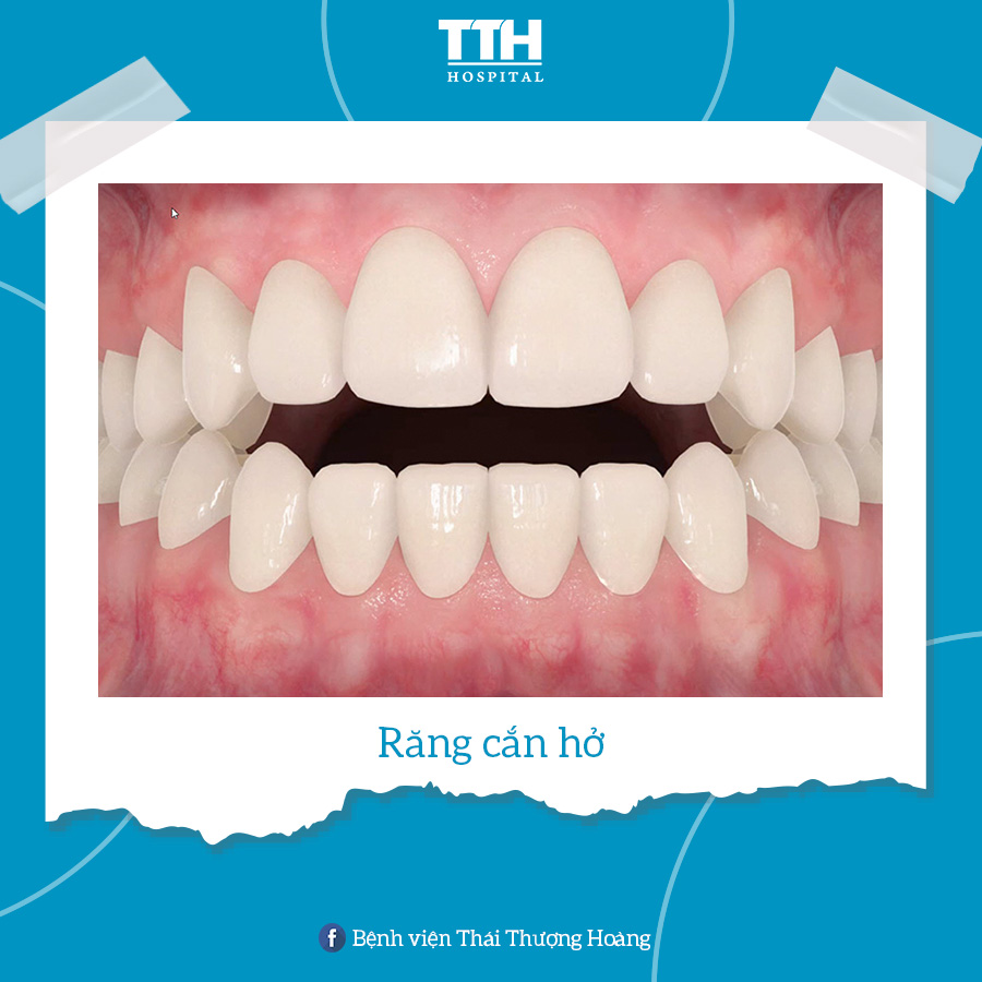 Răng cắn hở là tình trạng phần răng cửa trên và phần răng cửa dưới không chạm nhau khi cắn hai hàm lại mà có một khoảng cách giữa 2 hàm