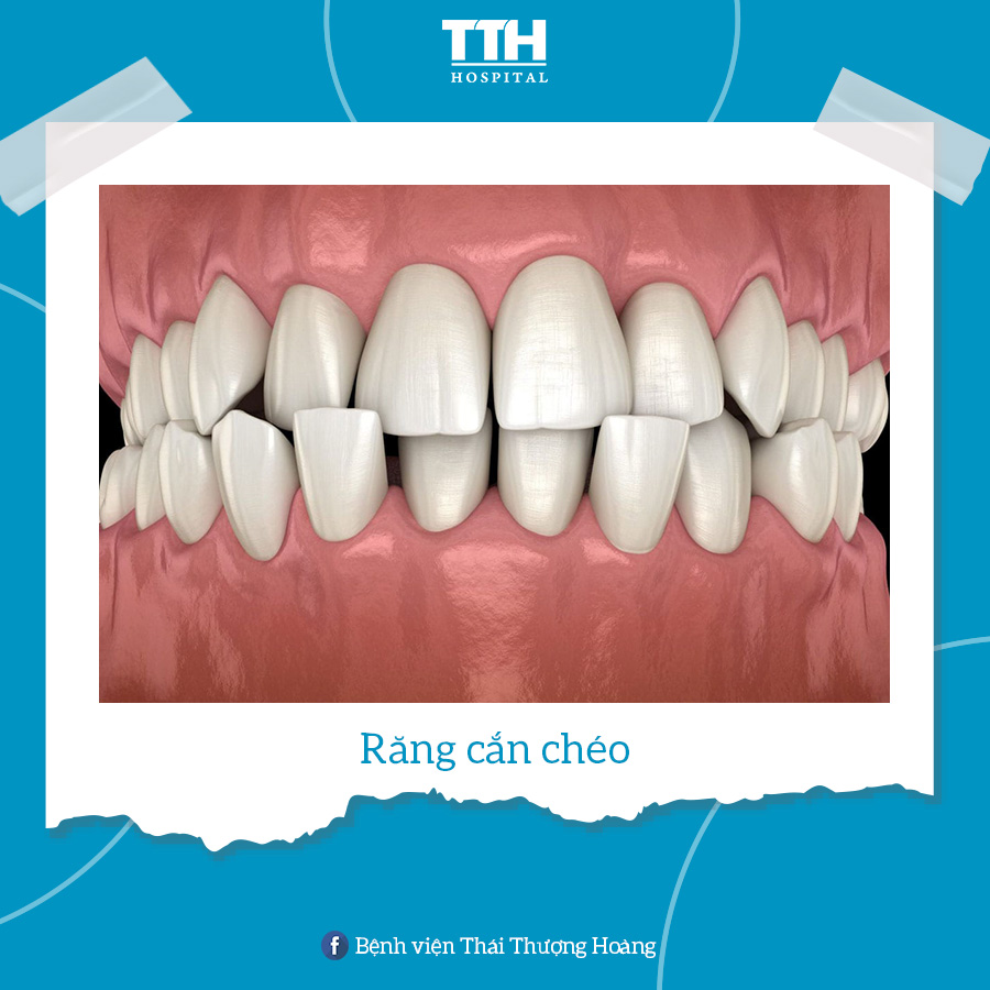 Răng cắn chéo là tình trạng răng trên và răng dưới không thẳng hàng nhau