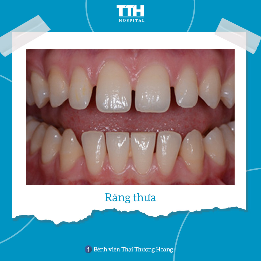 Răng thưa là việc xuất hiện các khoảng trống giữa hai hoặc nhiều răng
