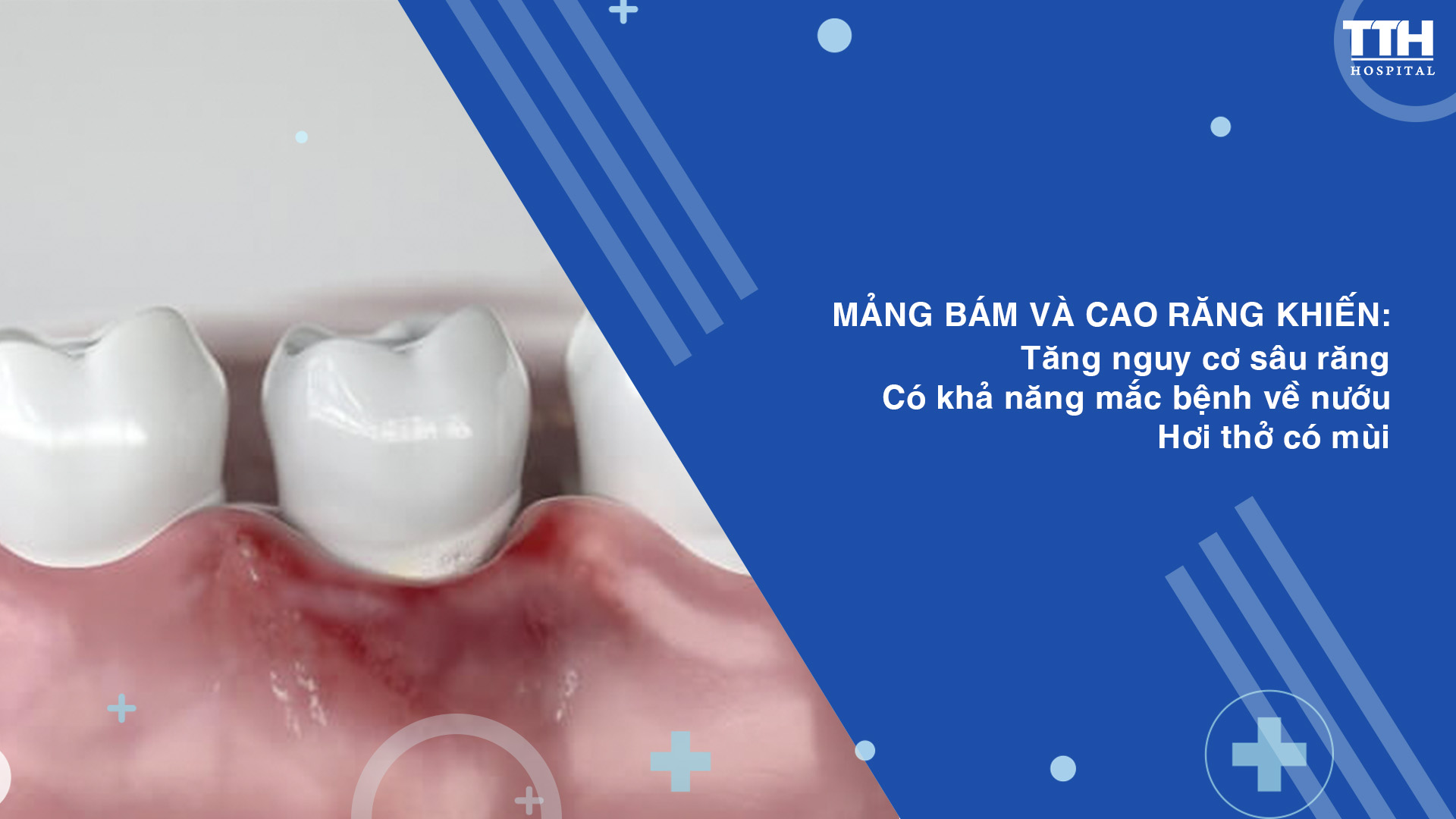 LÀM SẠCH MẢNG BÁM CAO RĂNG