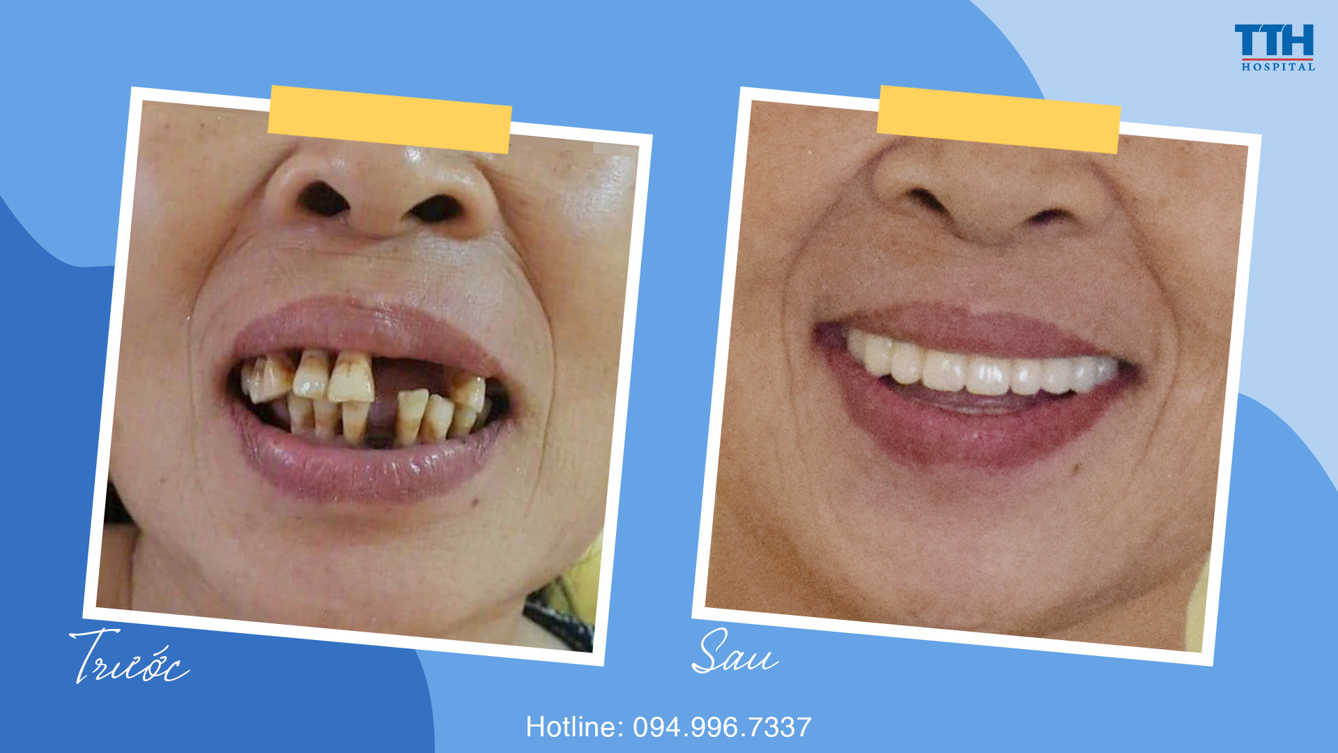 NHỮNG ƯU ĐIỂM CỦA TRỒNG RĂNG IMPLANT