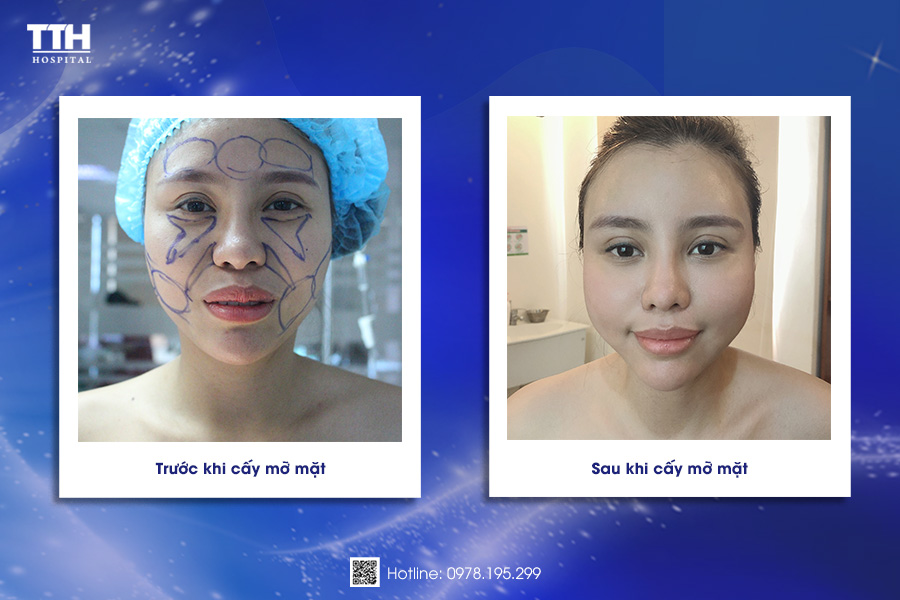 Kết quả khách hàng cấy mỡ mặt Baby Face tại Thái Thượng Hoàng