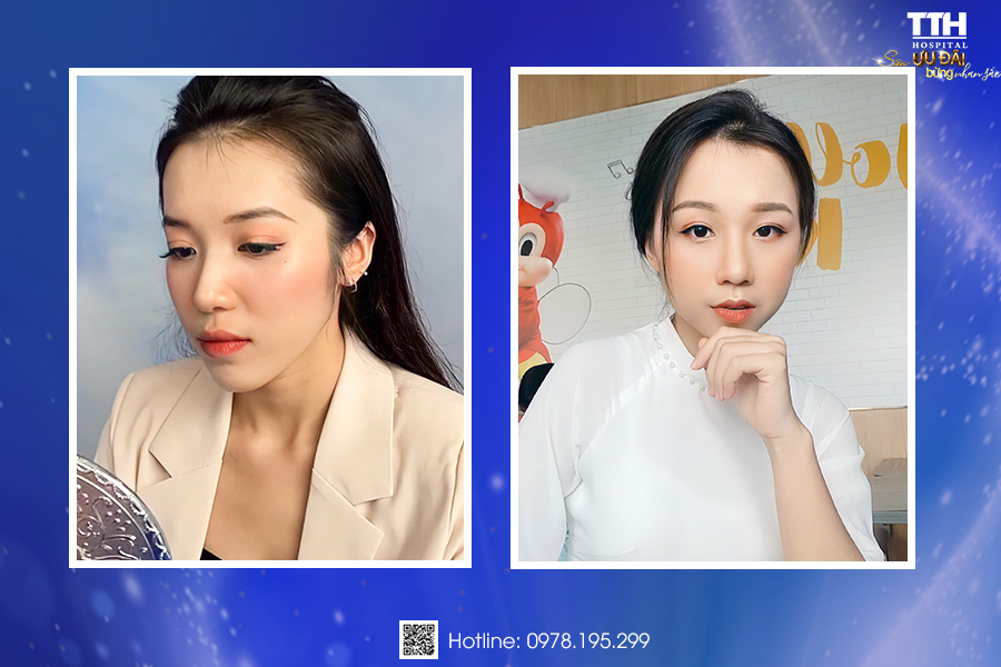 Hình ảnh khách hàng sau khi nâng mũi tại Thái Thượng Hoàng