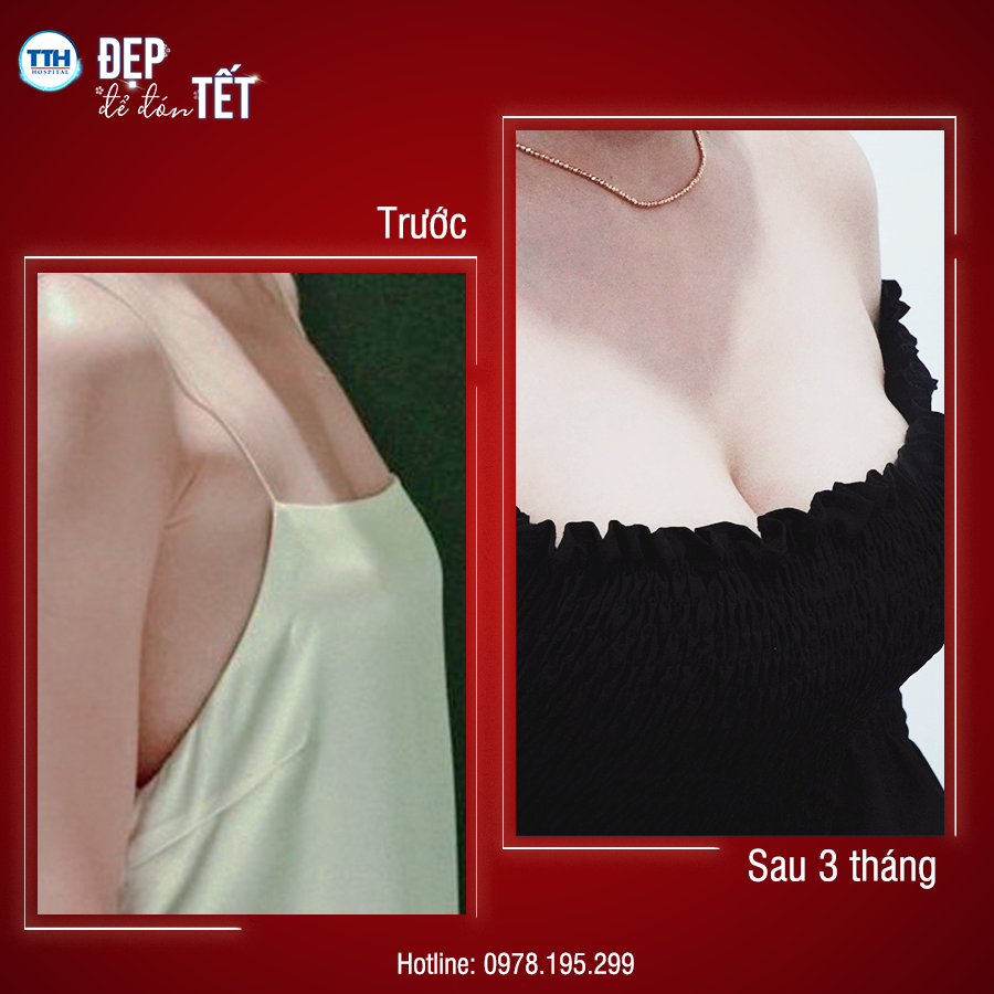 BỆNH VIỆN THÁI THƯỢNG HOÀNG - ĐỊA CHỈ NÂNG NGỰC UY TÍN TẠI NGHỆ AN