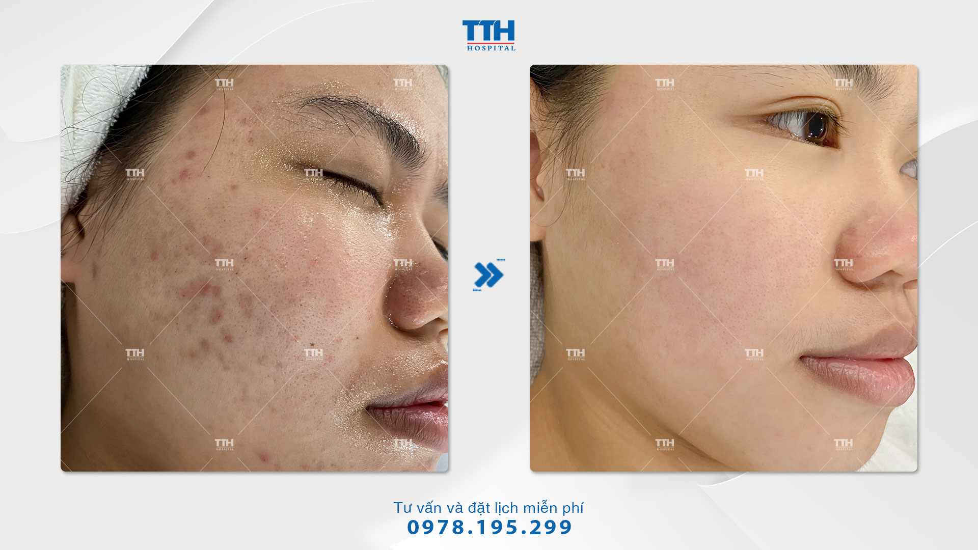công nghệ ánh sáng sinh học IPL 