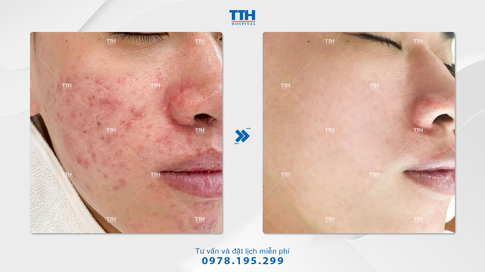 IPL là tên viết tắt của Intense Pulsed Light, là một nguồn ánh sáng dạng xung