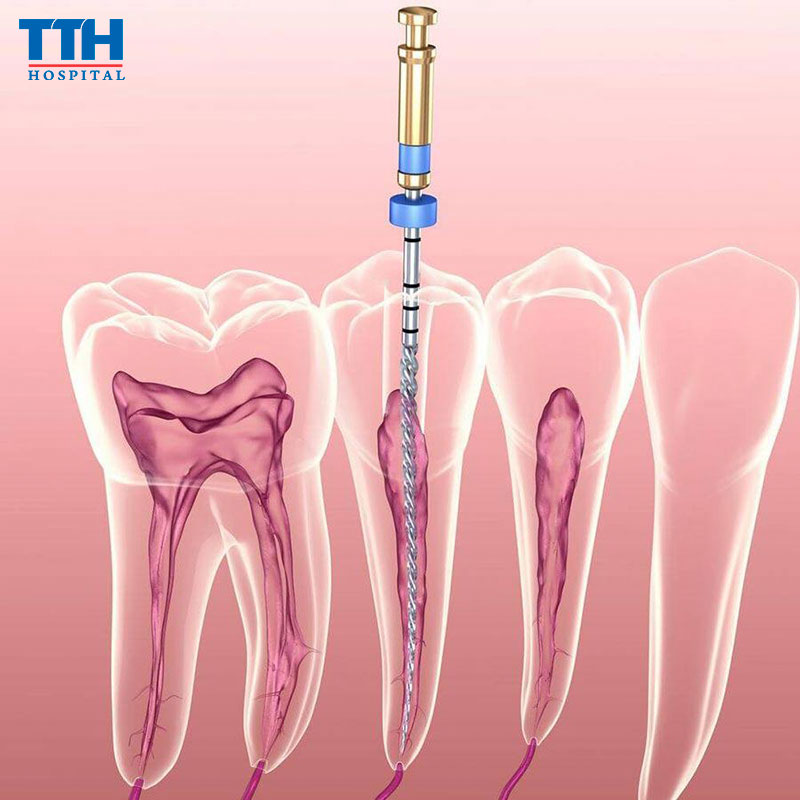 Ưu điểm của phương pháp điều trị tủy kỹ thuật cao