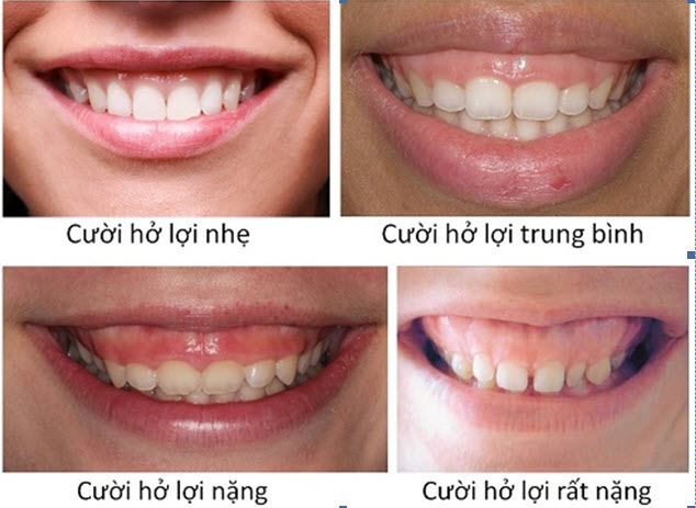 QUY TRÌNH THỰC HIỆN CHỮA CƯỜI HỞ LỢI