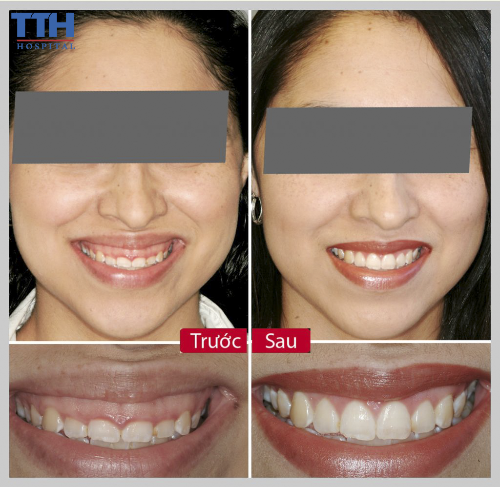 HÌNH ẢNH TRƯỚC VÀ SAU KHI CHỮA CƯỜI HỞ LỢI