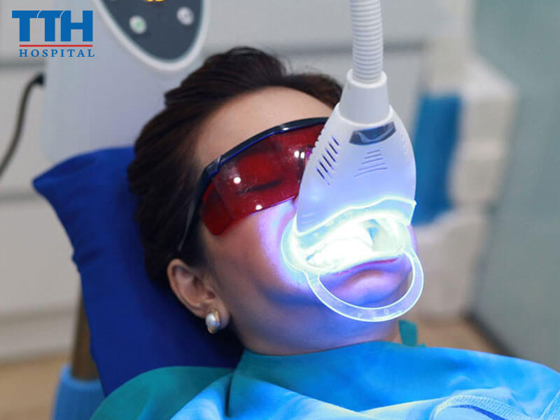 Địa chỉ tẩy trắng răng hiệu quả tại Nghệ An