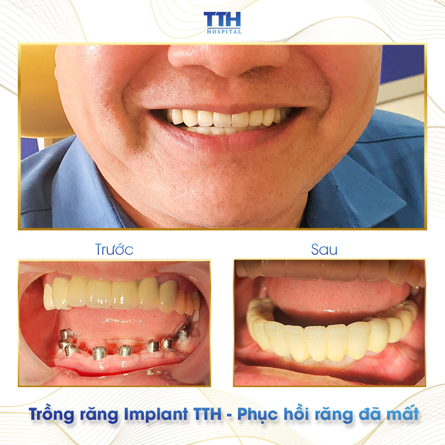 Kết quả trồng răng Implant của khách hàng tại Bệnh viện Thái Thượng Hoàng