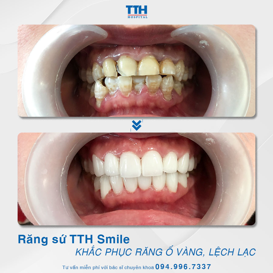 Răng là bộ phận duy nhất trên cơ thể không có khả năng tái tạo và phục hồi