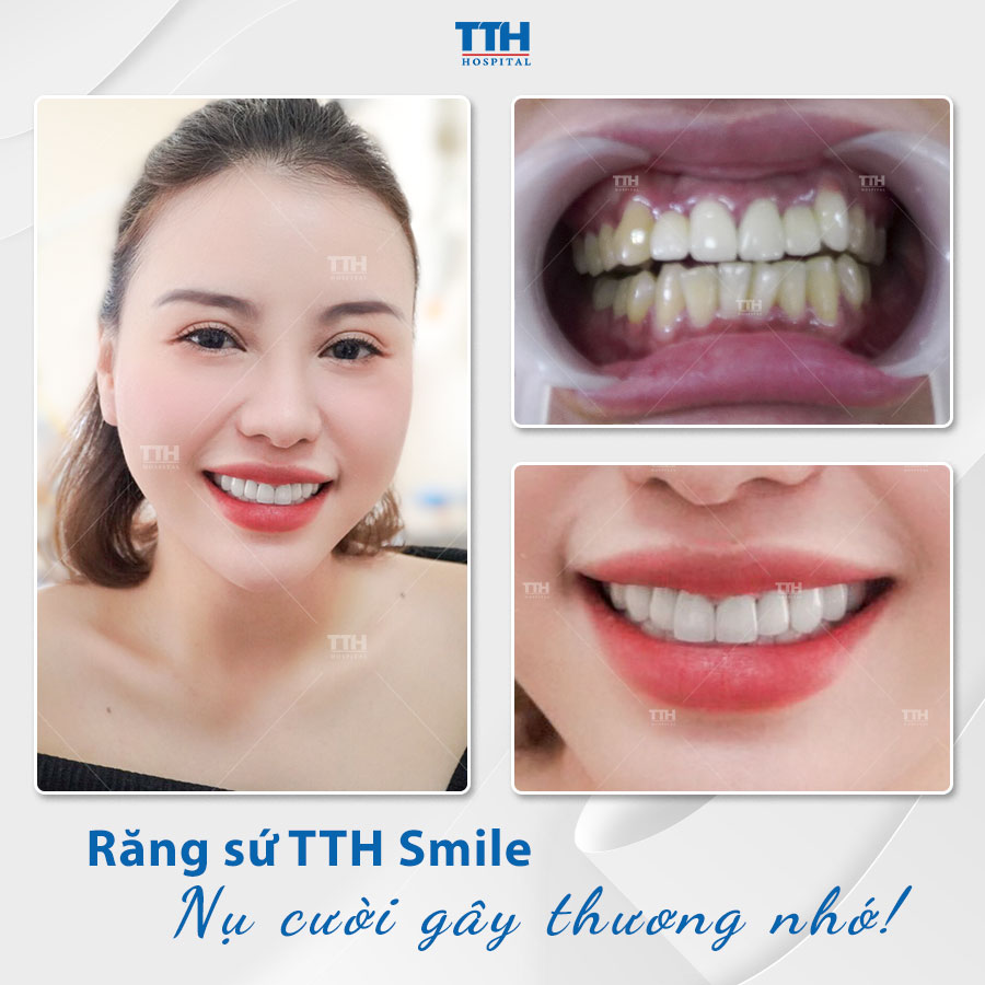 Ưu điểm bọc răng sứ thẩm mỹ 5