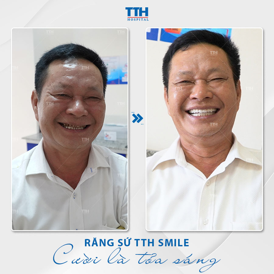 Ưu điểm bọc răng sứ thẩm mỹ 4