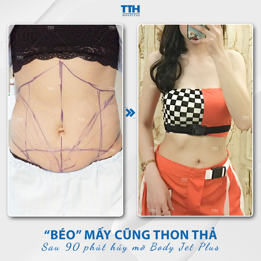Một vài lưu ý hút mỡ bụng sau sinh