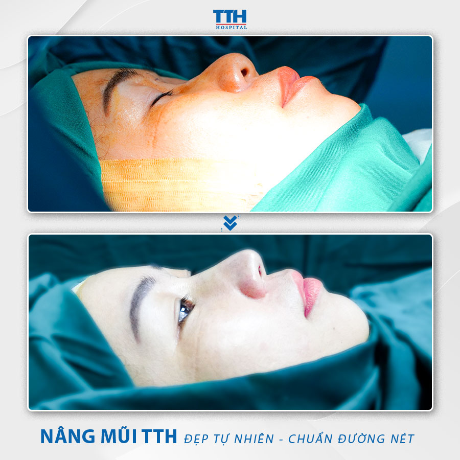 Loạt hình ảnh khách hàng sau nâng mũi tại Bệnh viện Thái Thượng Hoàng 4
