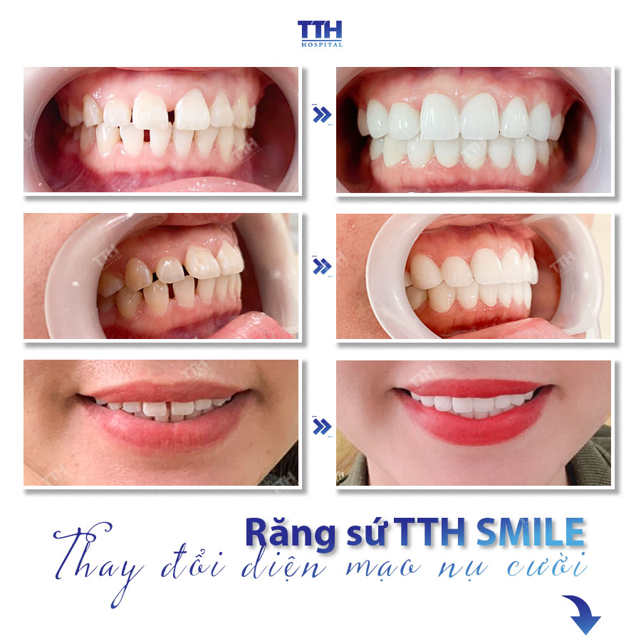 Các trường hợp nên bọc răng sứ thẩm mỹ