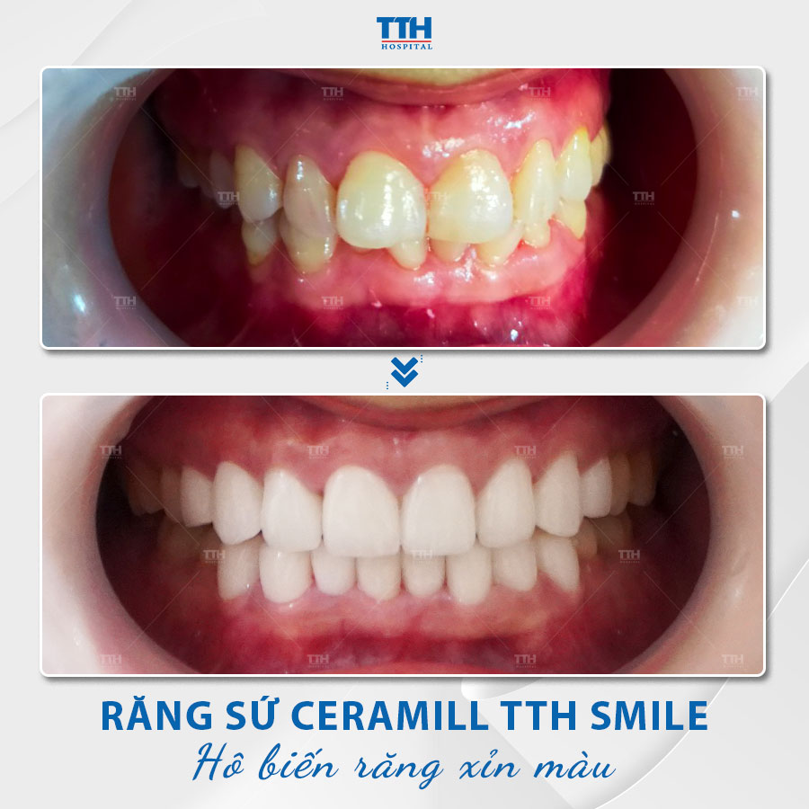 Răng sứ thẩm mỹ được đánh giá cao trong việc phục hình lại cho các tình trạng răng