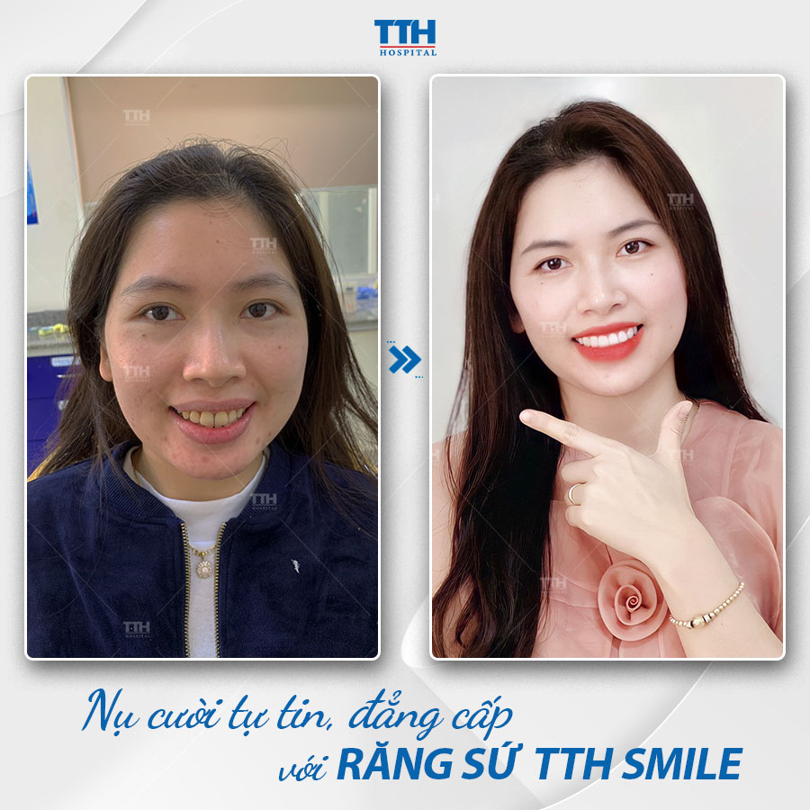 Ưu điểm bọc răng sứ thẩm mỹ 2