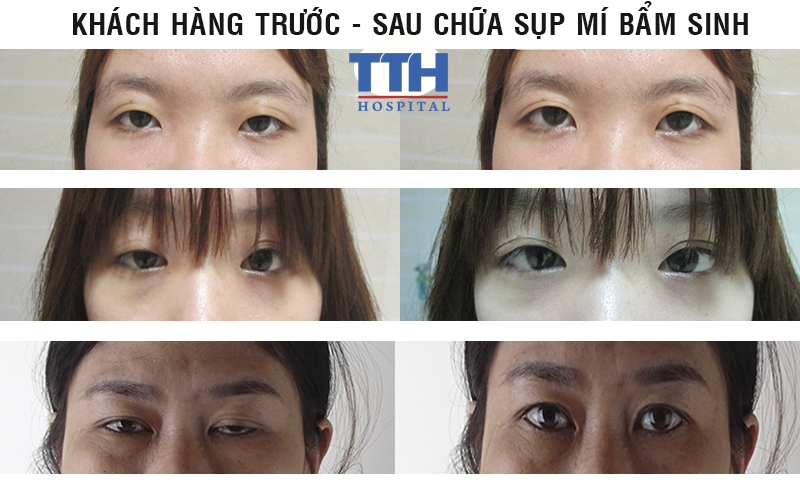 Một số hình ảnh điều trị sụp mí mắt bẩm sinh tại Bệnh viện Thái Thượng Hoàng