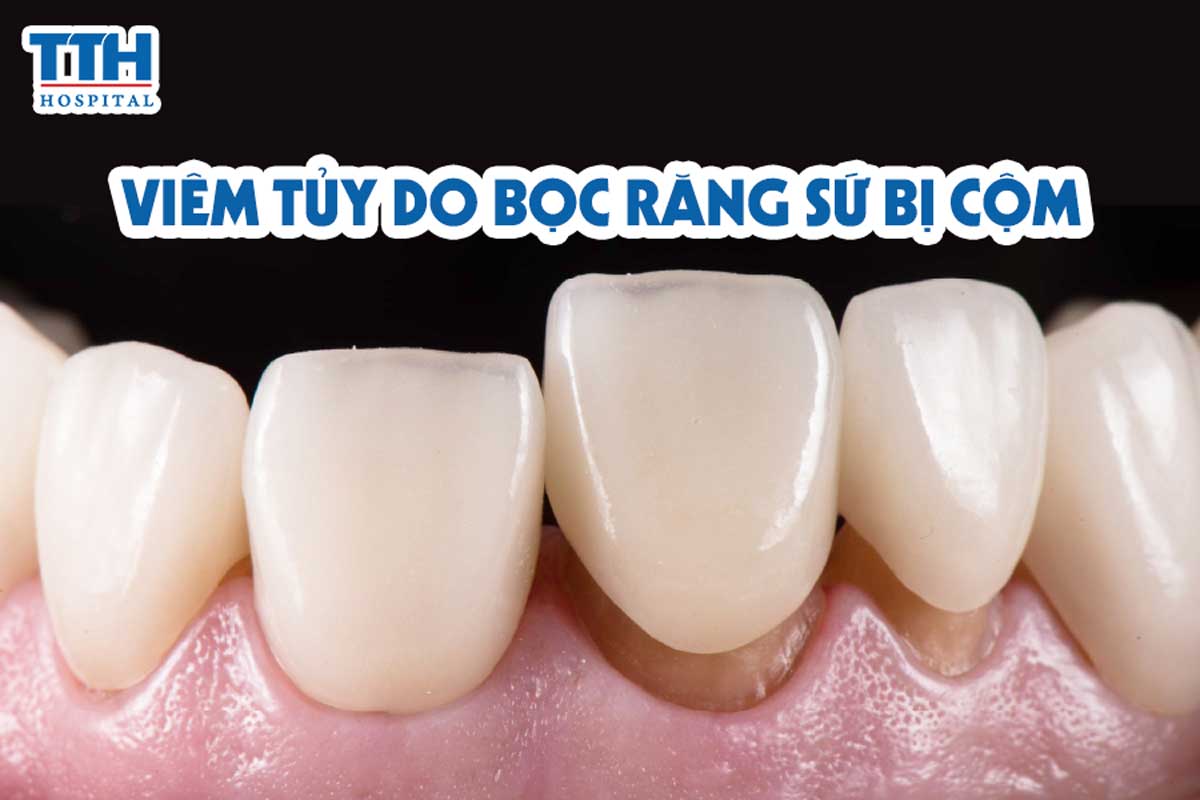 Viêm tủy do bọc răng sứ bị cộm
