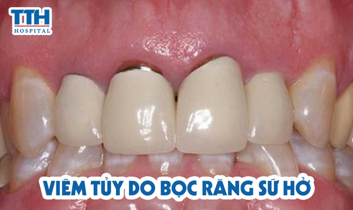 Viêm tủy do bọc răng sứ không khít