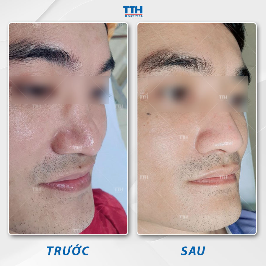 Loạt hình ảnh khách hàng sau nâng mũi tại Bệnh viện Thái Thượng Hoàng 1
