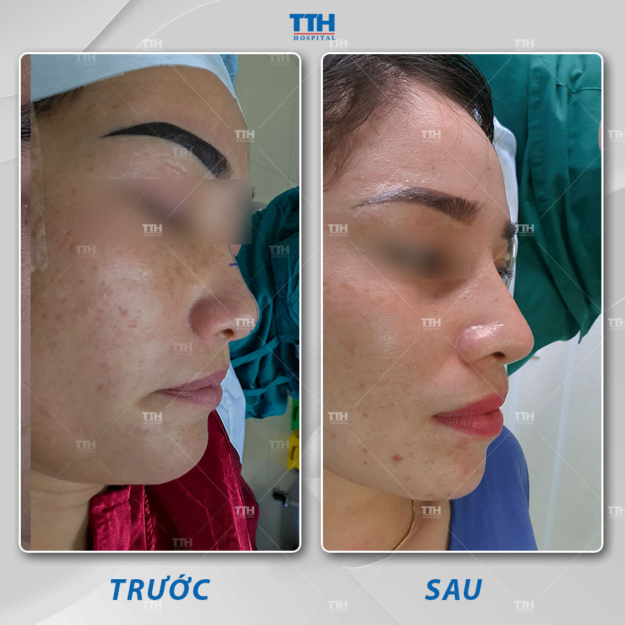 Loạt hình ảnh khách hàng sau nâng mũi tại Bệnh viện Thái Thượng Hoàng 2