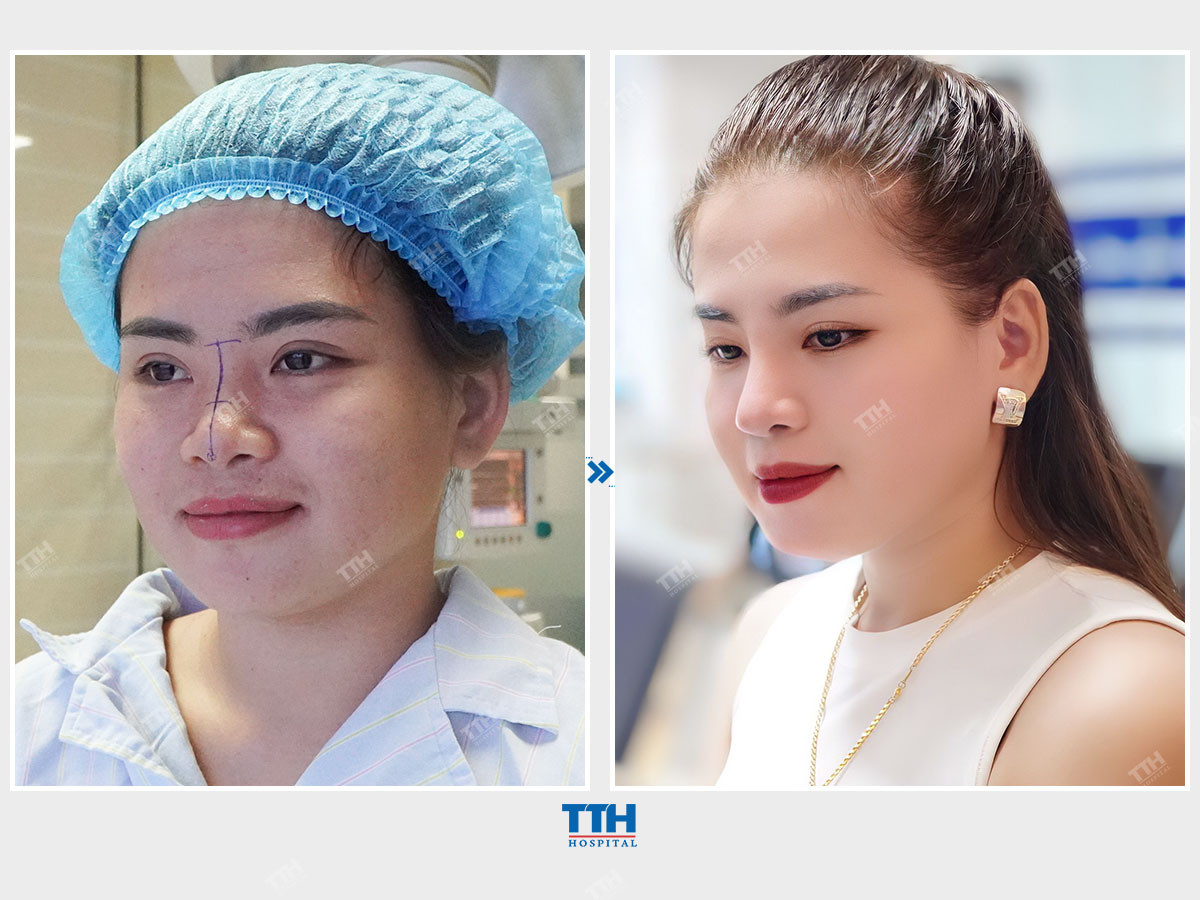 Loạt hình ảnh khách hàng sau nâng mũi tại Bệnh viện Thái Thượng Hoàng 5