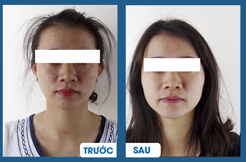 Điều trị mụn trước - sau