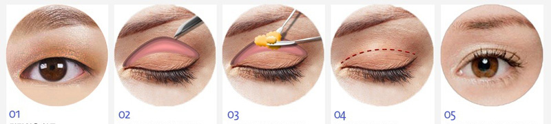 Phẫu thuật cắt mí mắt sửa lại tại Bệnh viện Thái Thượng Hoàng