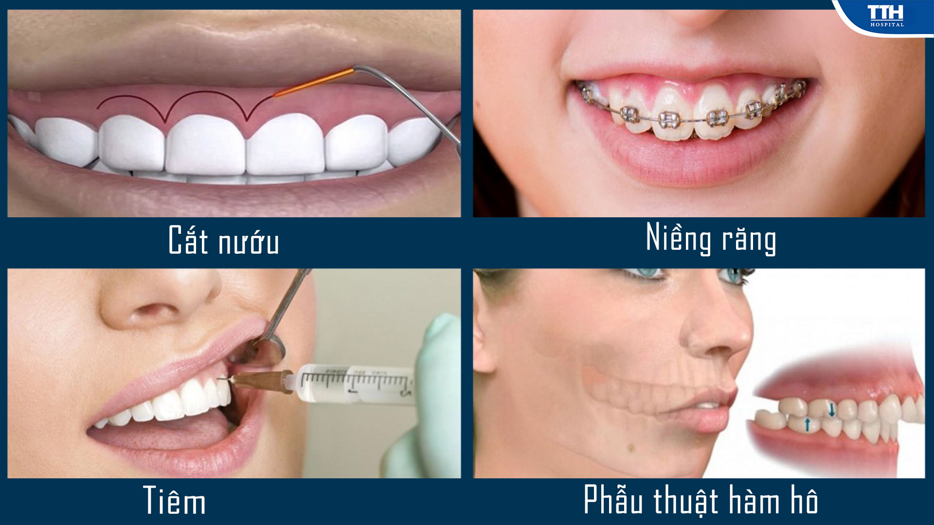 các phương pháp khác phục hở lợi