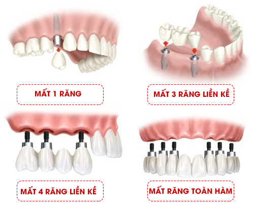 Các trường hợp mất răng đều có thể sử dụng Trụ Implant Alef