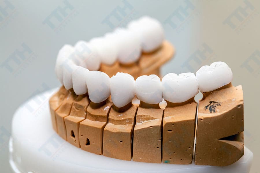 Các Yếu Tố Ảnh Hưởng Đến Chi Phí Bọc Răng Sứ