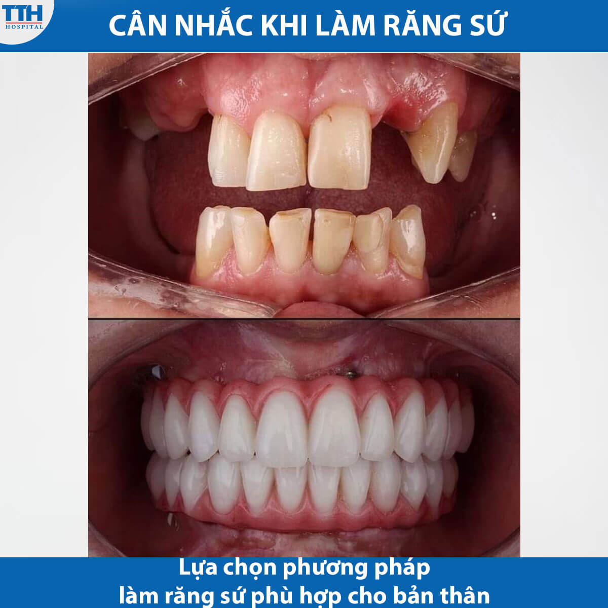 Cân nhắc trước khi thực hiện làm răng sứ