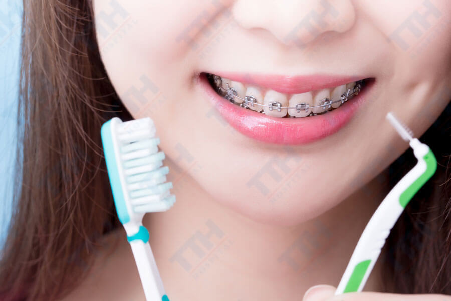 Chăm sóc răng miệng khi niềng răng ở tuổi 40