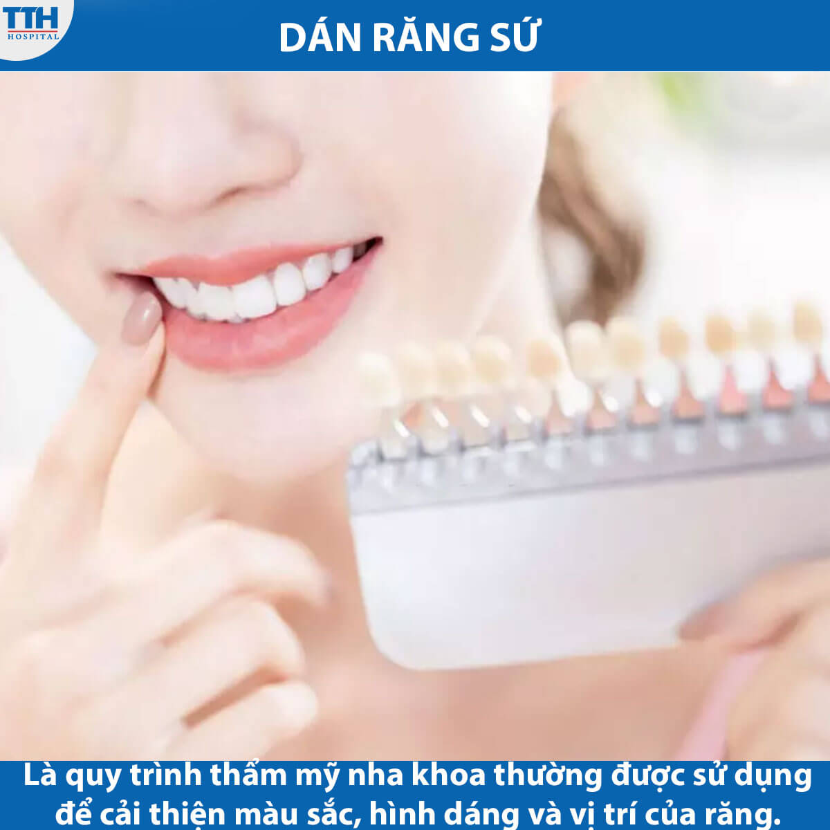 Dán răng sứ là gì