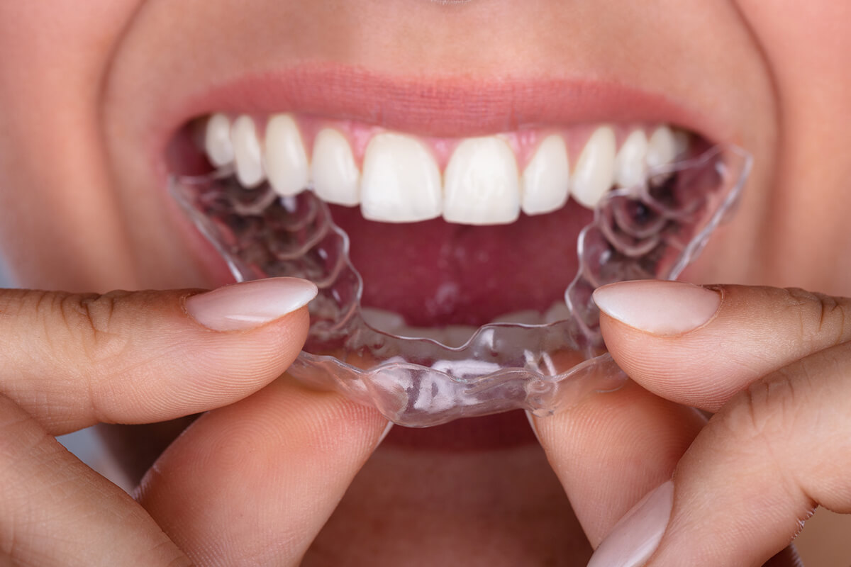Thẩm mỹ răng sứ không hoàn toàn giải quyết được vấn đề lệch lạc nặng