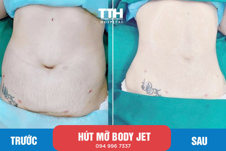 Những trường hợp phù hợp phương pháp nâng ngực bằng mỡ tự thân