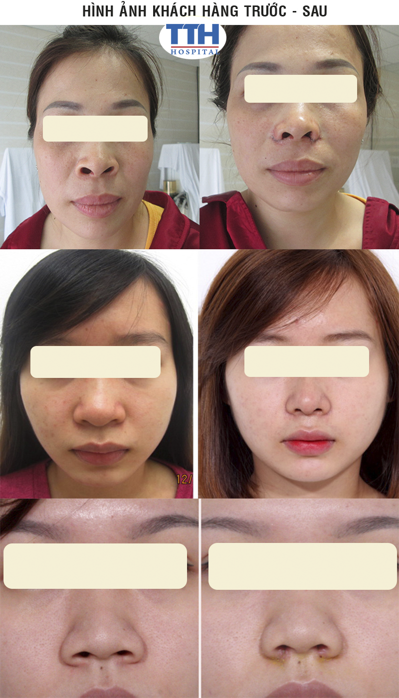 Quy trình tiểu phẫu thu gọn cánh mũi tại Bệnh viện Thái Thượng Hoàng