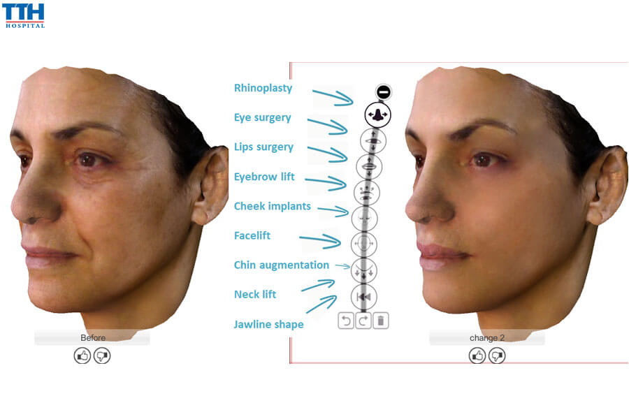 Lợi ích của việc áp dụng công nghệ Crisalix trong phẫu thuật cắt mí