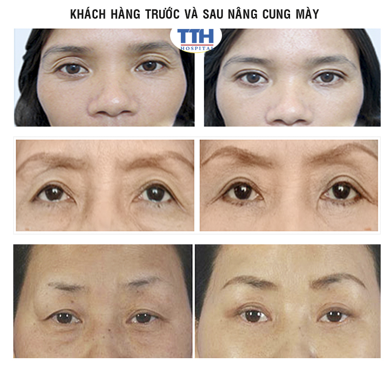 Giúp loại bỏ vùng xăm cung mày cũ mà không cần biện pháp tẩy xóa nào