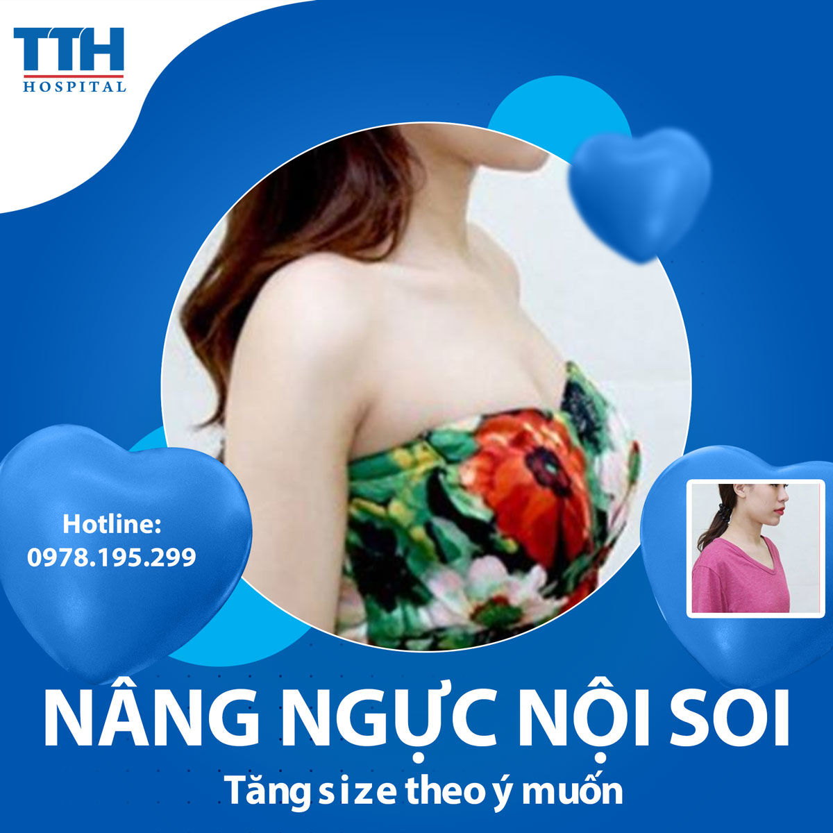 Một số hình ảnh kết quả nâng ngực
