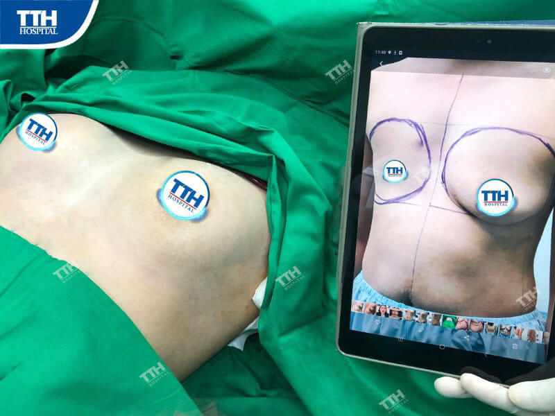 Nắm rõ các phương pháp nâng ngực phổ biến