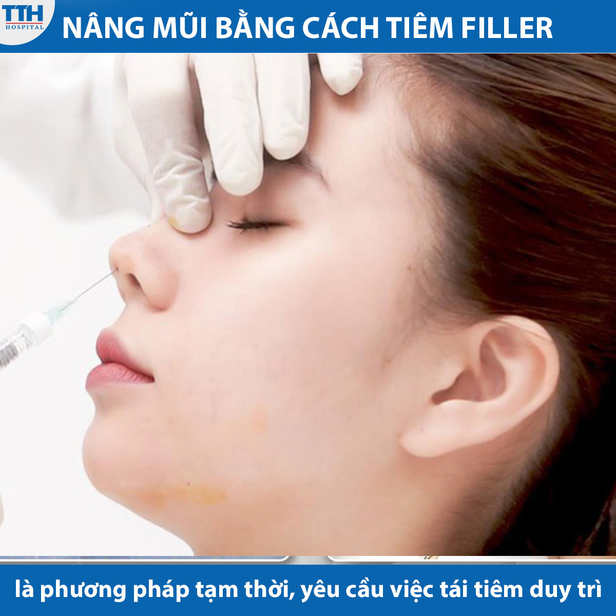 Nâng mũi bằng cách tiêm filler chỉ là phương pháp tạm thời và yêu cầu việc tái tiêm duy trì